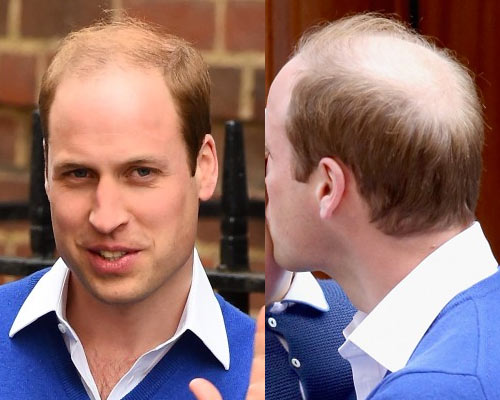 Prince-William-Hairstyles-for-Bald-Spot